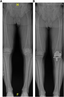 Frontiers | Alignment Options And Robotics In Total Knee Arthroplasty